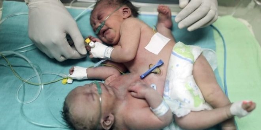Yapışık İkizler Gazze Dışında Tedavi Edilmezse Ölebilir!