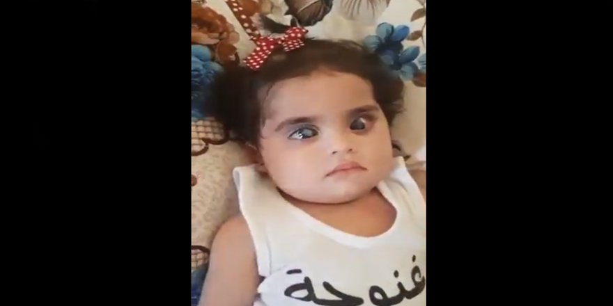 İdlib’de doğuştan glokom hastalığı olan 9 aylık bebek tedavi için yardım bekliyor