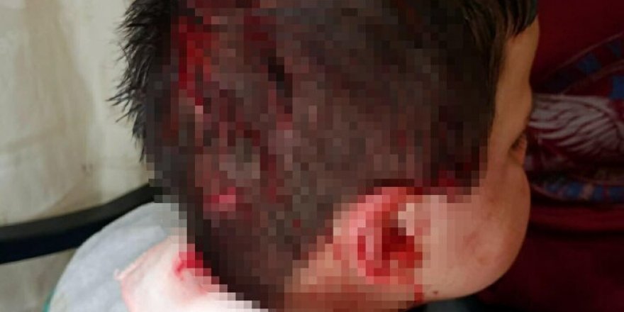 Yine pitbull dehşeti: Altı yaşındaki Hüseyin hastanelik oldu