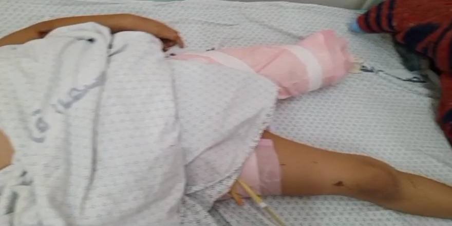 Siyonist İsrail vahşetinde bacağı kopan 10 yaşındaki Gazzeli çocuk Türkiye’den yardım bekliyor