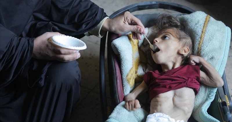 Gazze'de her gün yaklaşık 110 çocuk şiddetli açlık sebebiyle hastaneye kaldırılıyor