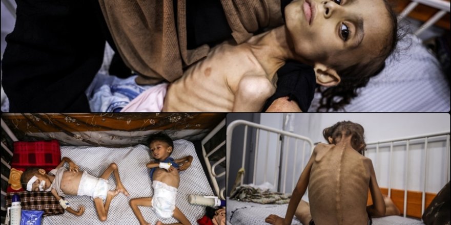 Kitlesel açlığın yaşandığı Gazze'deki doktor: Böyle şeyleri kitaplarda okurduk şimdi birebir şahit oluyoruz