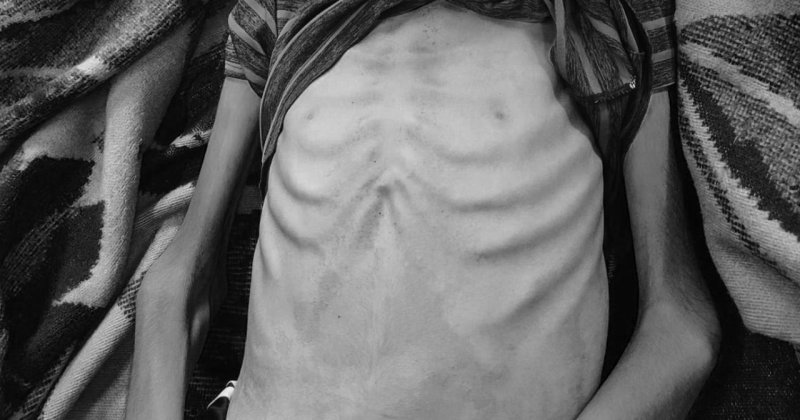 Gazze'de açlıktan  can verenlerin sayısı 140'ı çocuk 393'e yükseldi