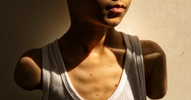 Gazze'de 42 bin kişi hayat boyu bakıma muhtaç