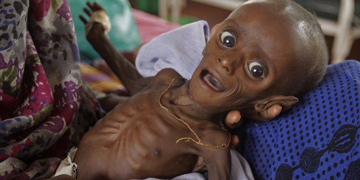 “Somali’de Çocuklar Adeta Birer Kemik Yığını Gibi”
