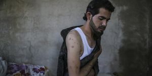 Şarapnel Parçalarına Rağmen Mücadeleye Devam!