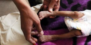 Yemen Halkının Yüzde 80'i Yardıma Muhtaç