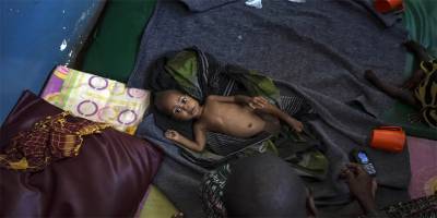 Somali’de çocuklar açlıktan ölüyor!