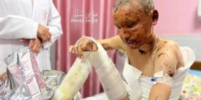 Heryeri yanan  Filistinli çocuk yeterli tedavi alamıyor