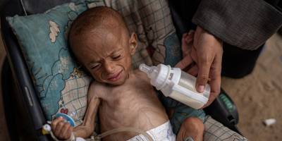 Gazze’de çocuklar açlıktan görme yetilerini kaybediyor