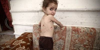 Gazze'de yaklaşık 19 bin çocuk akut açlık çekiyor