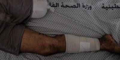 Gazze'de ölüm, ampütasyondan daha kolay görünüyor