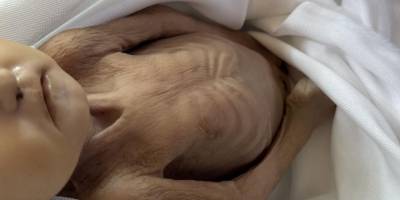 Gazze'de 10 kişi daha açlıktan hayatını kaybetti