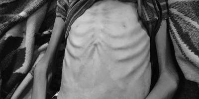 Gazze'de açlıktan  can verenlerin sayısı 140'ı çocuk 393'e yükseldi