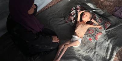 Gazzeli 10 yaşındaki Nafız açlıktan 8 kiloya düştü