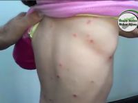 Suriye’de Bir Tehlike Daha: Cilt Kanseri