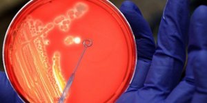 Endonezya'da 27 Kişide Şarbon Tespit Edildi