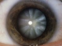 Çinli Doktorlar Kök Hücrelerle Kataraktı Tedavi Etti